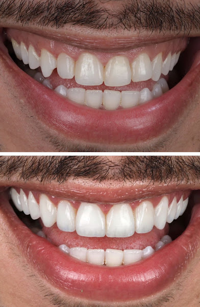 Foto 2 de Dr. Diego Carvalho | Facetas de Resina | Consultório Odontológico