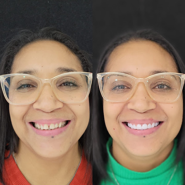 Foto 2 de Dr. Douglas Ricceri - Facetas em Resina Composta, Clareamento Dental e Clínico-Geral