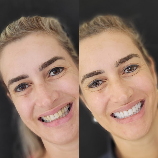 Foto 3 de Dr. Douglas Ricceri - Facetas em Resina Composta, Clareamento Dental e Clínico-Geral