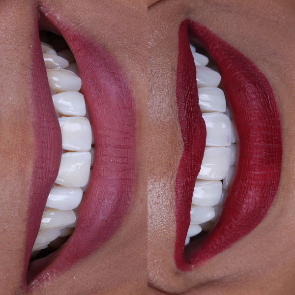 Foto 3 de Dr. Edrys Ali Barizi | Facetas de Resina e Porcelana | Dentista