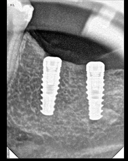 Foto 3 de Dr. Edson oliveira implantes, urgências, extração SISO, CISO, proteses.