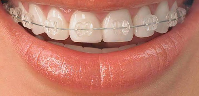 Foto 3 de Dr Eduardo Rocha Ortodontia Invisível em Fortaleza