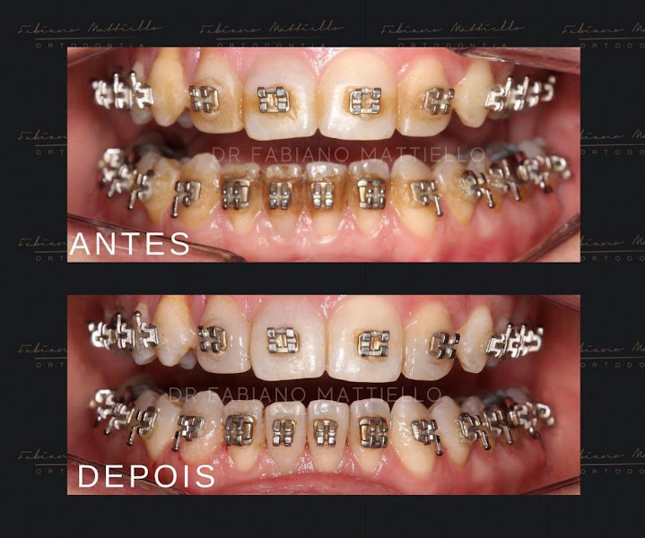 Foto 3 de Dr. Fabiano Mattiello | Mont'Serrat - Porto Alegre - RS | Especialista em aparelho ortodôntico