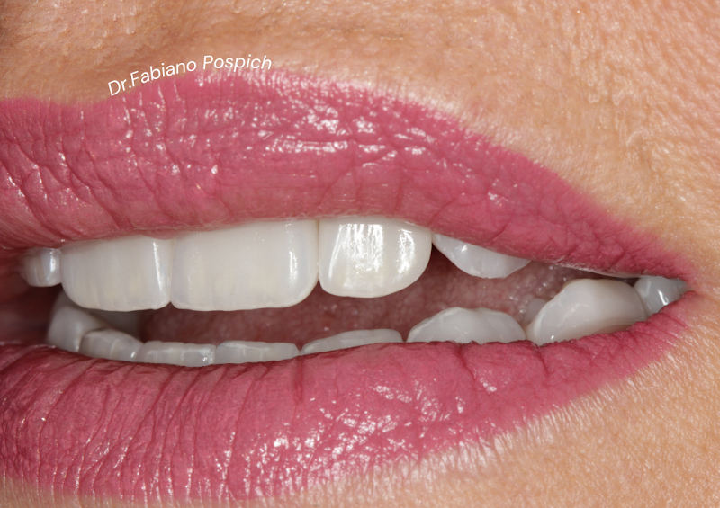 Foto 2 de Dr. Fabiano Pospich - Estética do Sorriso - Lentes de Contato - Implantes Dentários - Reabilitação Oral - Odontologia Digital