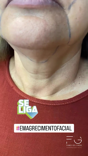 Foto 2 de Dr. Fabio Gelonese - Harmonização Facial em Bauru e São Paulo