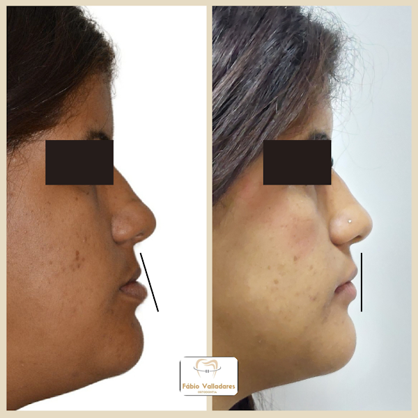 Foto 2 de Dr. Fábio Valladares Ortodontia - Aparelhos e Alinhadores Invisalign - Campo Grande