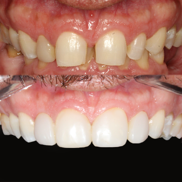 Foto 3 de Dr Felipe Zanella - Odontologia estética - Facetas e lentes de contato