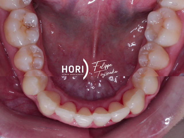 Foto 3 de Dr. Felippe Tsujinaka - Ortodontista Invisalign Doctor - Itaim Bibi