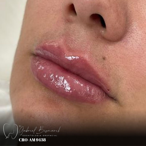 Foto 2 de Dr. Gabriel Bismarck | Especialista em Harmonização Orofacial