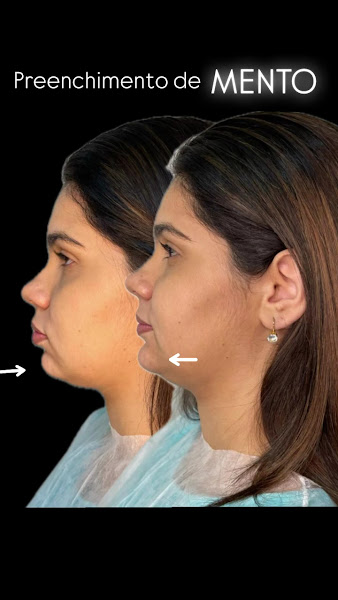 Foto 3 de Dr. Gabriel Bismarck | Especialista em Harmonização Orofacial