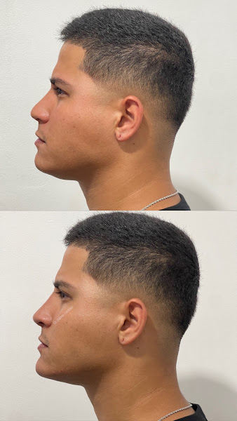 Foto 3 de Dr. Gabriel Cardoso | Harmonização Facial em São Gonçalo