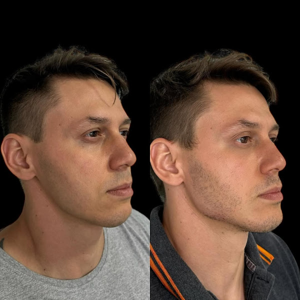 Foto 3 de Dr Gabriell Fernandes - Harmonização Orofacial