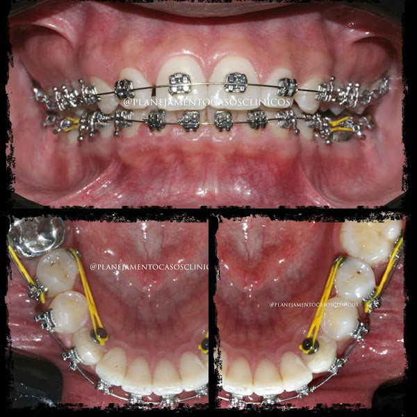 Foto 3 de Dr. Giovanni de Carvalho - Ortodontia e Estética - Curitiba/PR - Invisaling - Facetas em Resina - Alinhadores Invisíveis