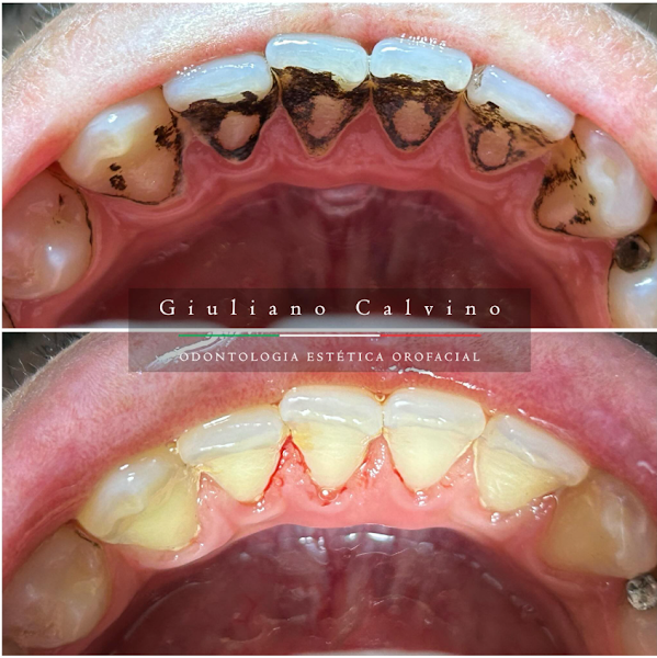 Foto 3 de Dr. Giuliano Calvino - Odontologia Estética e Restauradora✅