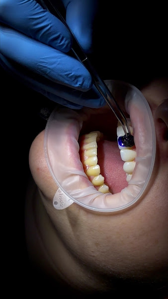 Foto 3 de Dr. Guilherme Maidana - Dentista em Campo Grande | Lentes em Resina | Airflow - Limpeza com Tecnologia | Aparelho Invisível