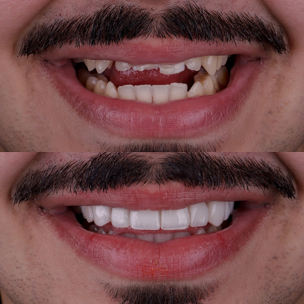 Foto 2 de Dr. Guilherme Mendonça - Lentes em Resina com Naturalidade