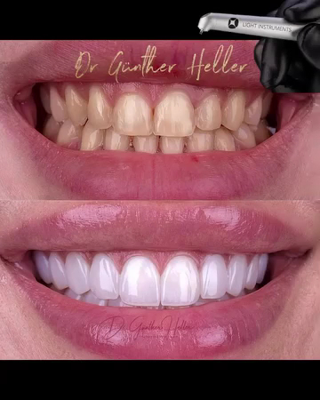 Foto 3 de Dr Gunther Heller Implante Dentário e Laser no tratamento do Ronco e Apneia, Facetas em Porto Alegre