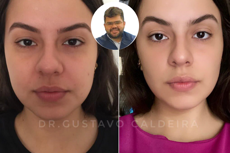 Foto 3 de Dr. Gustavo Caldeira | Harmonização facial em Montes Claros