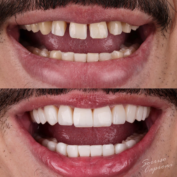 Foto 3 de Dr. Gustavo Caproni | Lentes em Resina Estratificadas