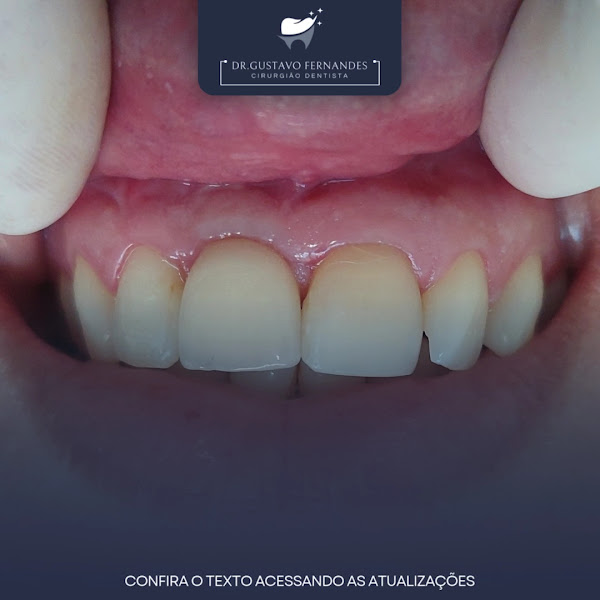 Foto 3 de Dr. Gustavo Fernandes | Tratamento de Canal Porto Alegre | Implante Dentário