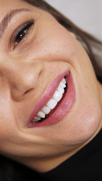 Foto 3 de Dr. Gustavo Henrique - Canal (tratamento endodôntico), Clareamento, Facetas de resina e Implante. Dentista em Contagem