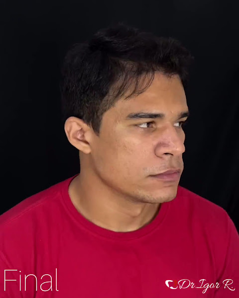 Foto 5 de Dr. Igor Ribeiro | igorribeiror | Harmonização Facial, Botox, Lentes Dentais