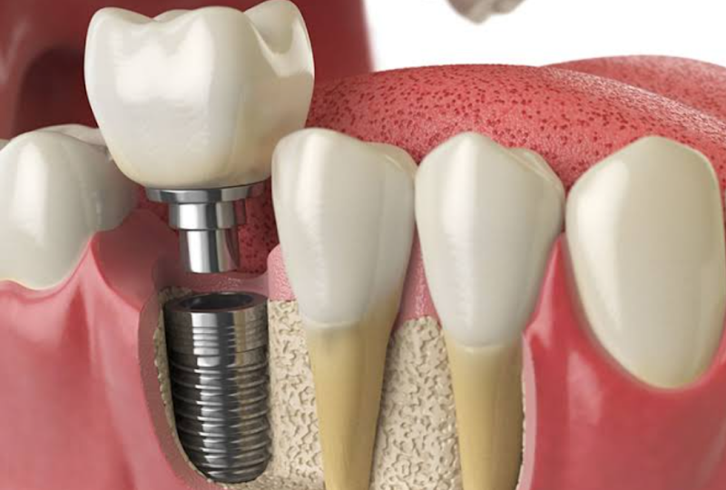 Foto 2 de Dr. Ivan de Sousa Implantes e cirurgias 8119-5583