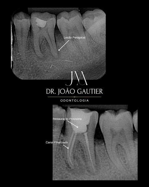 Foto 2 de Dr. João Gautier - Tratamento de Canal e Clínico Geral/ Facetas em Resina