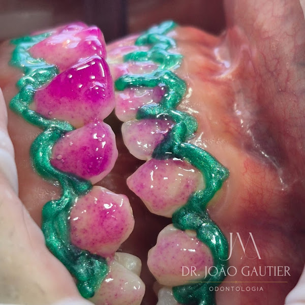 Foto 3 de Dr. João Gautier - Tratamento de Canal e Clínico Geral/ Facetas em Resina