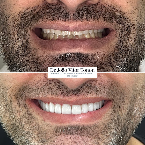 Foto 3 de Dr João Vitor Tonon - Harmonização Orofacial - Facetas e Lentes dentárias