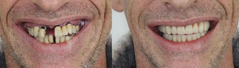 Foto 2 de Dr. John Andrade Implante Dentário | Lentes | Faceta | Prótese em Feira de Santana