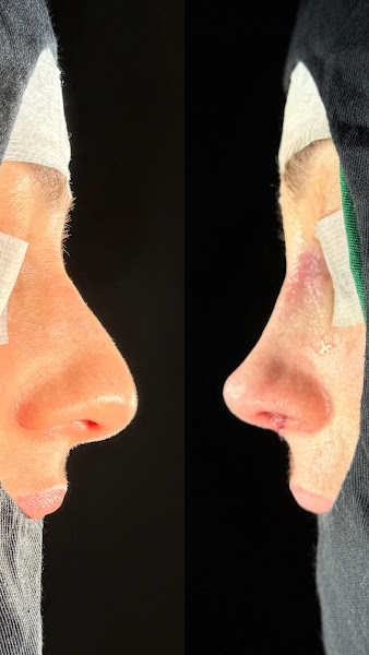 Foto 2 de Dr Jonas Spies - Rinoplastia
