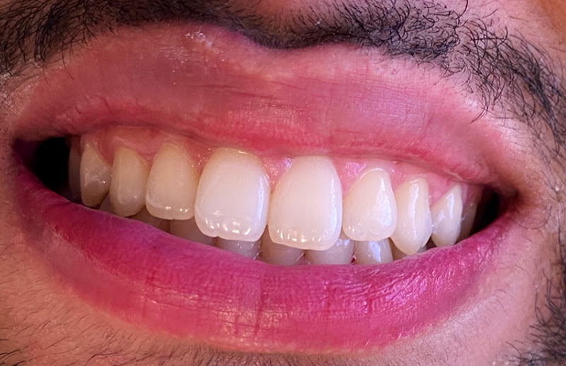 Foto 2 de DR JONATHAS JESUS | IMPLANTES DENTARIOS | POUSO ALEGRE | PROTESE PROTOCOLO | BOTOX |