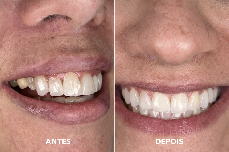 Foto 3 de Dr José Gomes | Facetas e Lentes em Resina