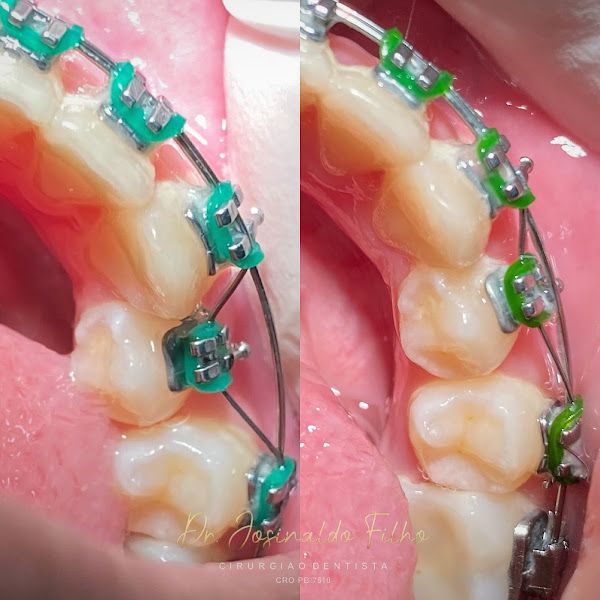 Foto 5 de Dr. Josinaldo Filho - Dentista em João Pessoa (Ortodontista Especialista/Aparelho Dental)