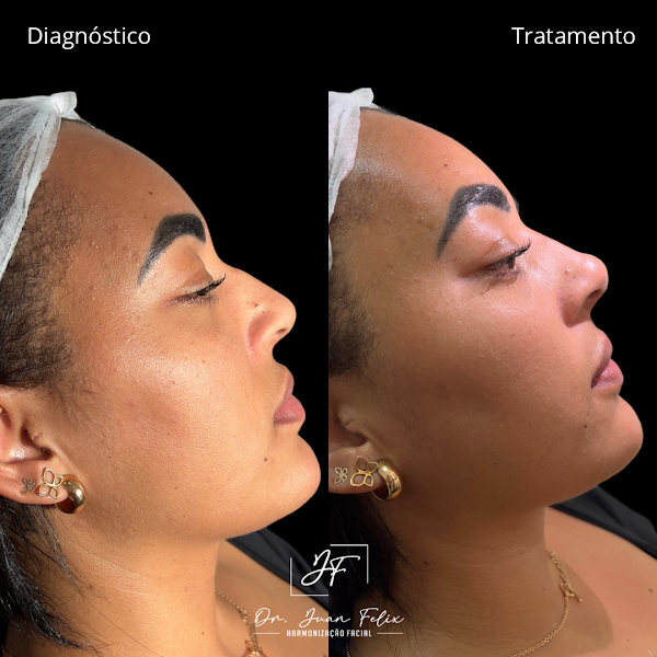 Foto 3 de Dr Juan Felix - Harmonização Facial Salvador