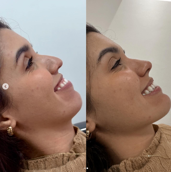 Foto 3 de Dr. Leandro Reis - Rinomodelação/ Preenchimento Labial / Harmonização e Botox
