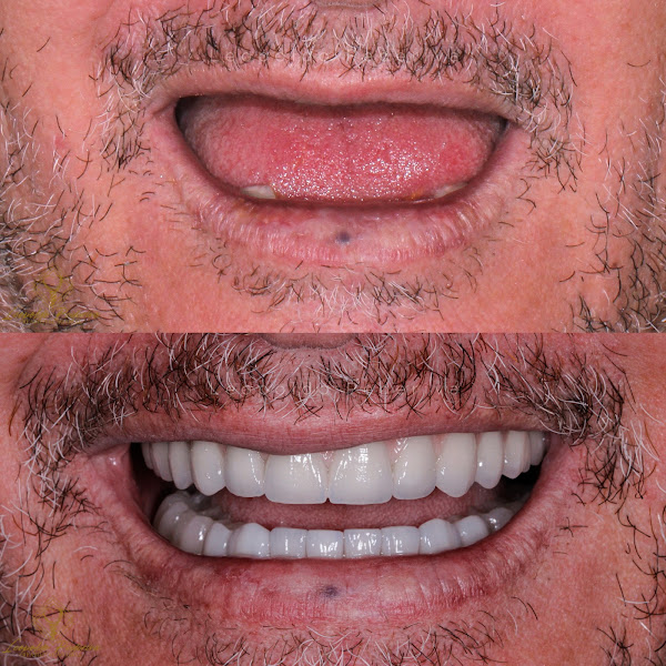 Foto 2 de Dr Leopoldo Pederiva - Implante Dentário em Dourados - Prótese Protocolo