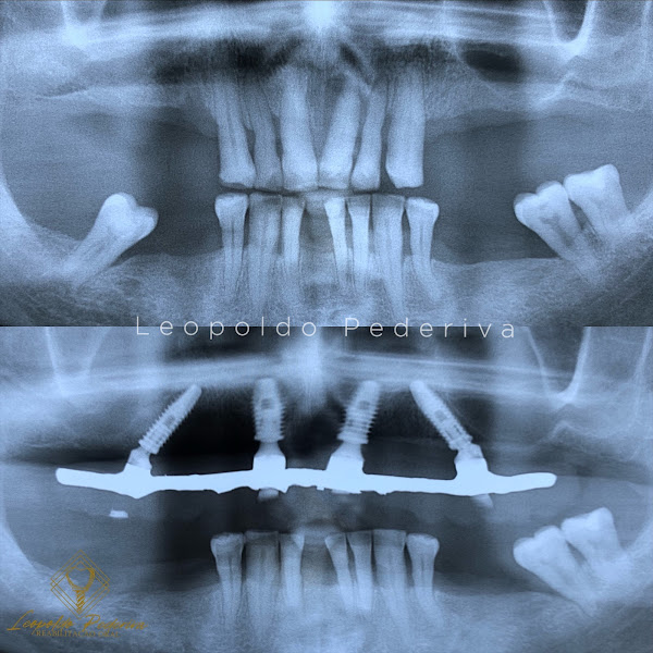 Foto 3 de Dr Leopoldo Pederiva - Implante Dentário em Dourados - Prótese Protocolo