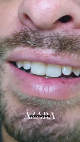 Foto 3 de Dr. Lucas Ázara | Dentista Limeira | Facetas | Lente dental