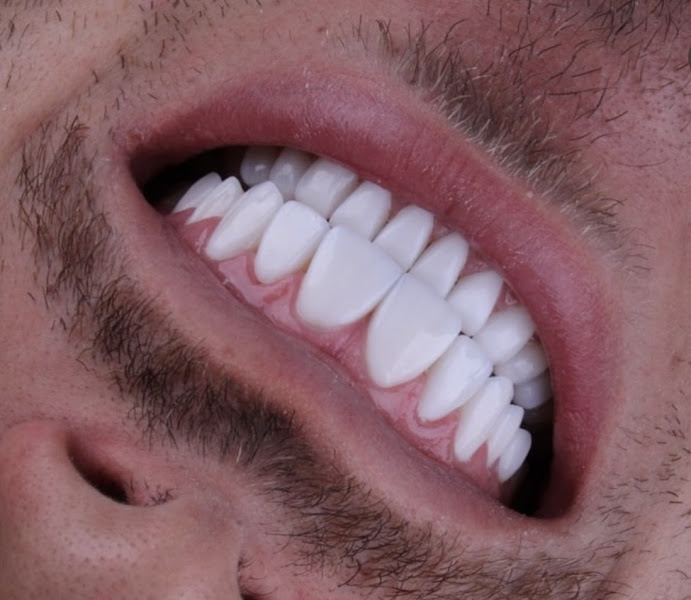 Foto 2 de Dr. Lucas Barbosa - Lente de Contato Dental