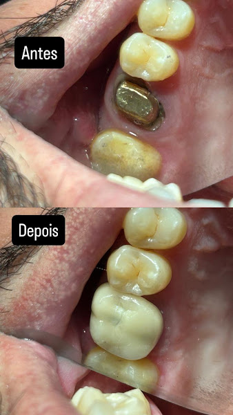 Foto 3 de Dr. Lucas Zilioli - Prótese Dentária em Americana