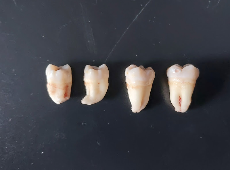 Foto 3 de Dr. Luciano Engelmann Morais - Cirurgia Bucomaxilofacial