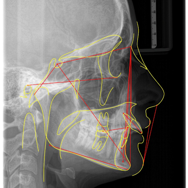 Foto 3 de Dr. Maiolino Thomaz - Ph.D em Cirurgia Bucomaxilofacial e Implantodontia