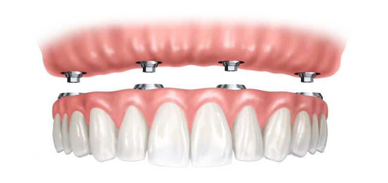 Foto 2 de Dr. Márcio Francci Dentista - Odontologia | Periodontia | Implantes | Protocolo