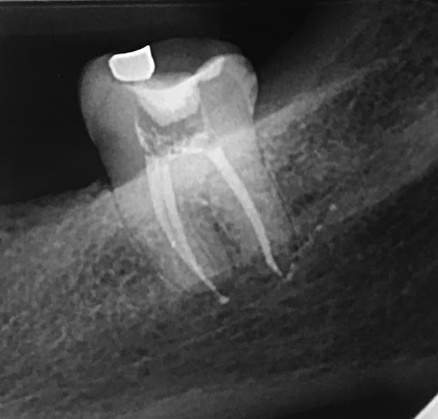 Foto 3 de Dr.Matheus Nunes -Endodontista- Tratamento de Canal com Microscópio INFLORI CLÍNICA