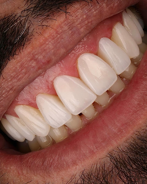 Foto 3 de Dr. Matheus Tombini | Facetas de Resina em Rio Grande