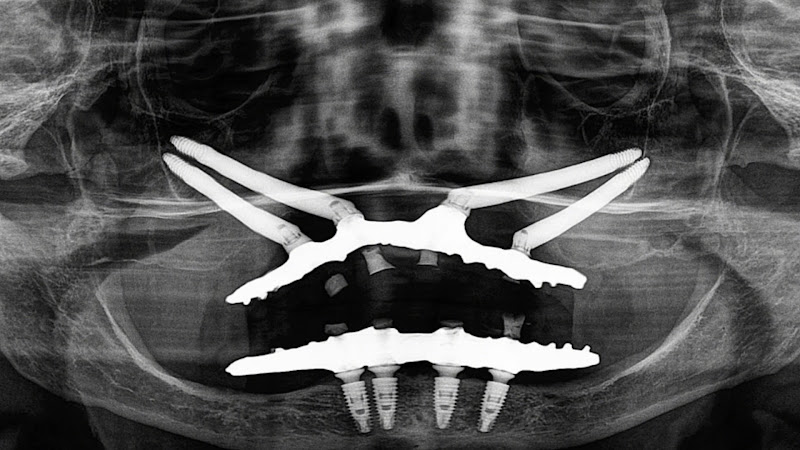 Foto 3 de Dr. Maxuel Oliveira / Implantes Dentários / Implantes Zigomáticos / Extrações Complexas / Rio Verde Goiás