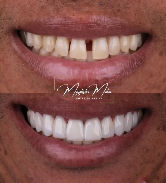 Foto de Dr. Maykson Mota - Lentes em Resina