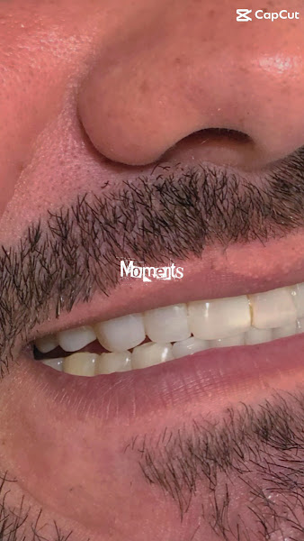 Foto 3 de Dr. Paulo Camurça. Tratamento de Canal , Implante e Prótese. Dentista Fortaleza José Walter